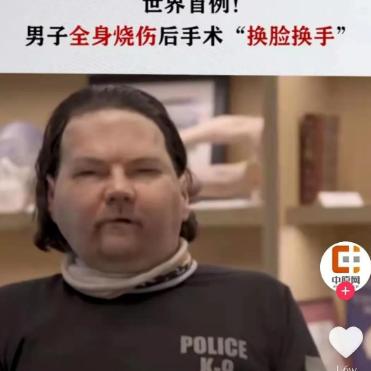 全球首例成功换脸换手男子即将步入婚姻殿堂，生命奇迹与爱的力量